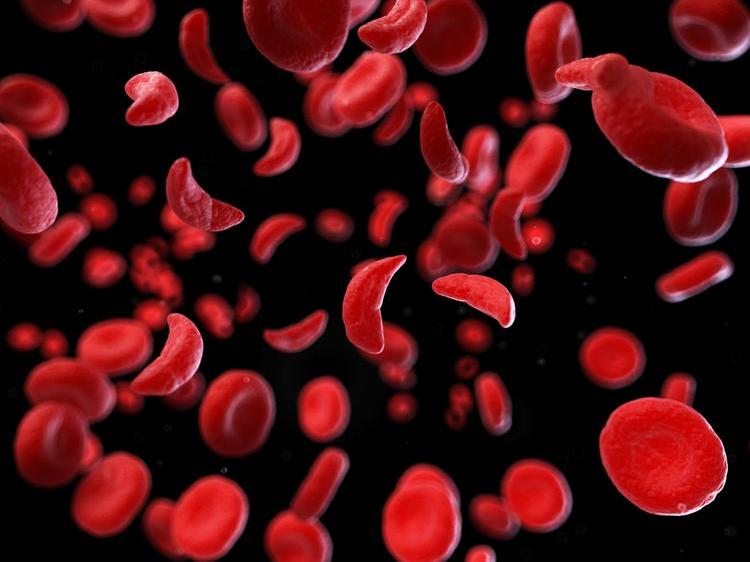 sickle-cell-blood-cells.jpg