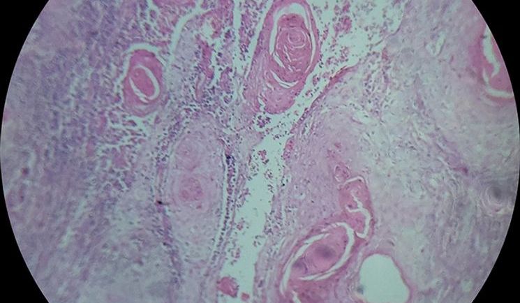 Squamous cell carcinoma with H&E staining_sm.jpg