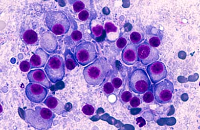 A microscopic image of multiple myeloma.