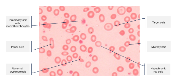 Blood film features of iron deficiency anaemia.